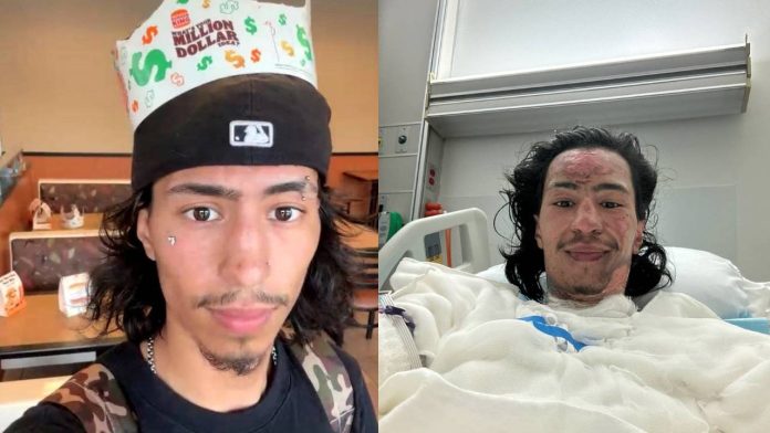 Mikol, desenvolvedor da criptomoeda Truth or Dare (DARE) antes e após ter seu corpo queimado em brincadeira para chamar atenção de investidores. Fonte: Redes sociais/Reprodução.