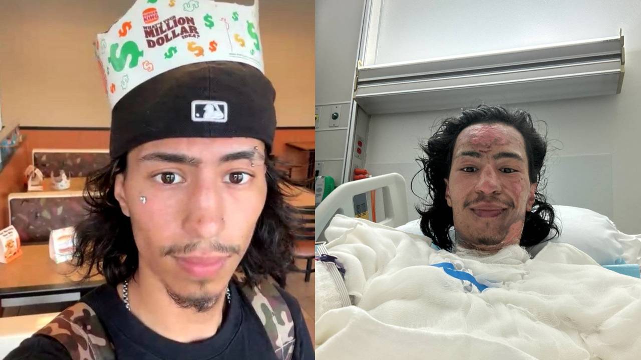 Mikol, desenvolvedor da criptomoeda Truth or Dare (DARE) antes e após ter seu corpo queimado em brincadeira para chamar atenção de investidores. Fonte: Redes sociais/Reprodução.